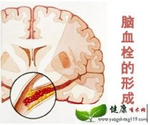 <b>秋季要预防脑血栓的发生</b>