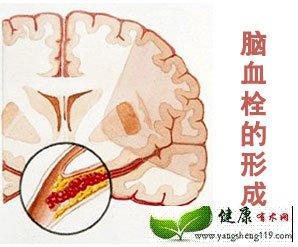 秋季防脑血栓