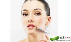 专业解答左脸长痘痘是什么原因并支招