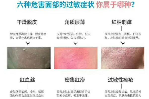 <b>红血丝脸用麦吉丽护肤品可以吗，贵妇膏可以</b>