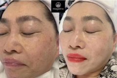 <b>麦吉丽三部曲祛皱纹效果好不好，听说能淡斑</b>