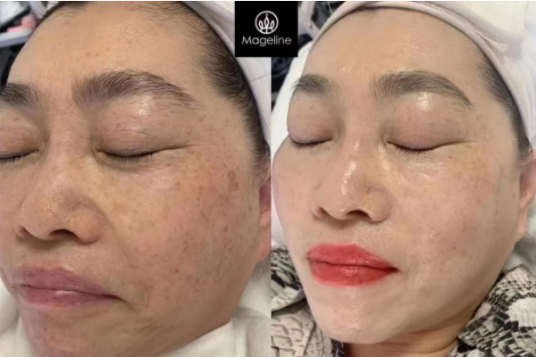 麦吉丽三部曲祛皱纹效果好不好，听说能淡斑？